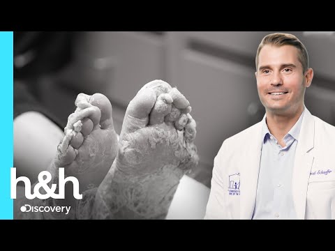 O maior fungo no pé que o doutor Brad já viu | Meus Pés Estão Me Matando | Discovery H&H Brasil