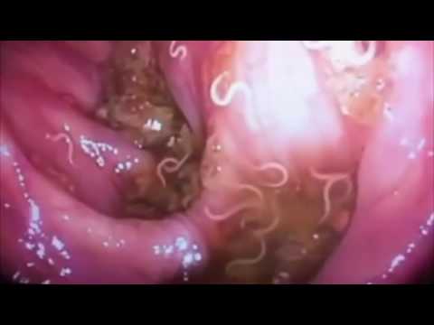 круглые черви паразиты человека фото круглые черви паразиты человека фото