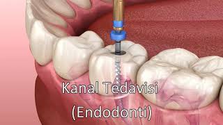 Kanal Tedavisi Endodonti