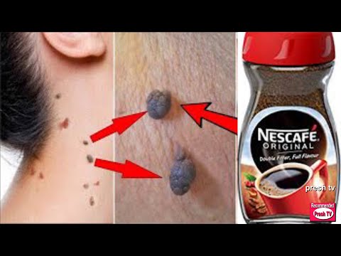 HOW TO REMOVE SKIN TAGS OVERNIGHT WITH COFFEE | HOW TO GET RID OF SKIN TAGS | SKIN TAGS REMOVAL