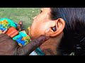 Unbelievable Tooth Worm removal from ear !! the most easiest way