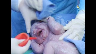 من غرفة العمليات.. الولادة القيصرية  د. ياسر إسماعيل - اختصاصي بالأمراض النسائية وجراحتها