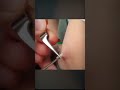 【閲覧注意】ニキビが腫れてたので中身を出したらまさかの…