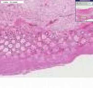 Histopathology Colon --Pseudomembranous colitis