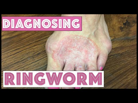 How we diagnose Ringworm (Tinea Corporis)