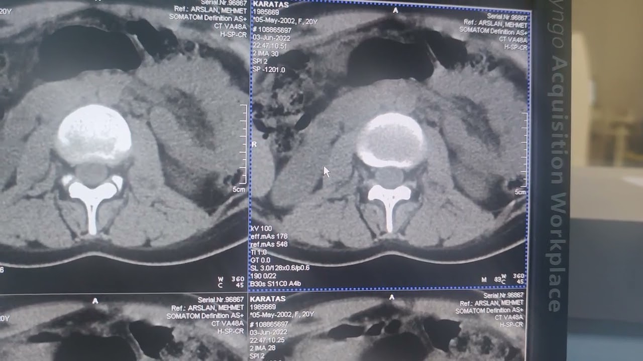 Lomber tomografi  Radyolojik Anatomi. Lomber tomografi görüntüsü nasıl