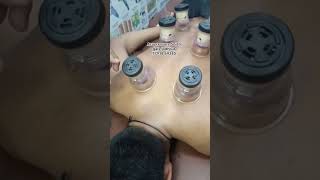 moxa cupping treatment therapy