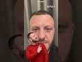Çfarë ndodh pasi të keni kryer mbjelljen e flokëve?🤔