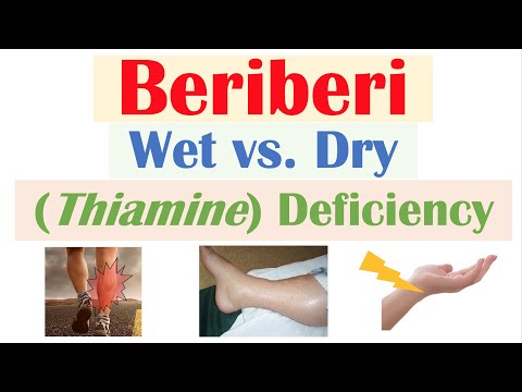 Beriberi (Thiamine Deficiency): Wet vs Dry Beriberi, Pathophysiology, Symptoms, Diagnosis, Treatment