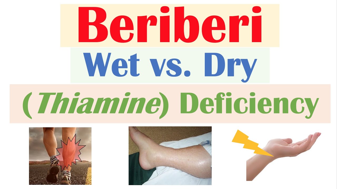 Beriberi (Thiamine Deficiency): Wet vs Dry Beriberi, Pathophysiology, Symptoms, Diagnosis, Treatment - YouTube