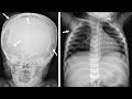 HISTIOCITOSIS X : Lesiones óseas en niños, Fibrosis pulmonar , Descamación seborreica en piel.