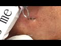 Blackheads and Cysts