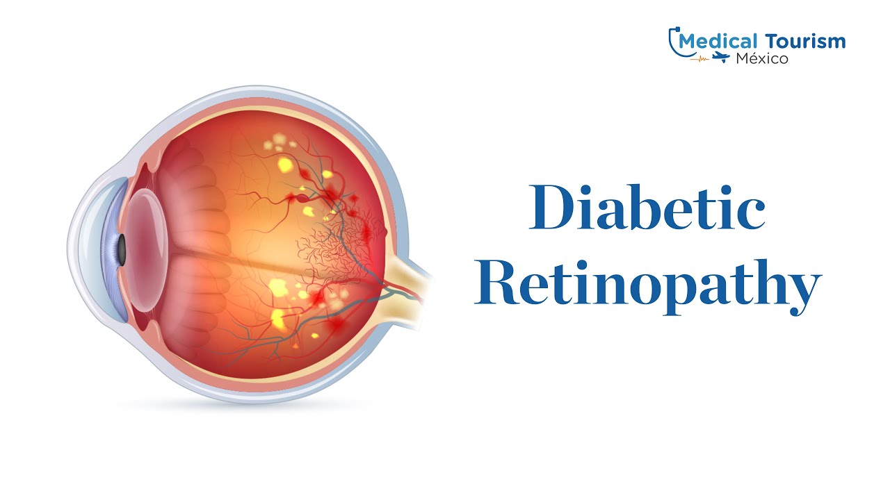 Diabetic Retinopathy Procedure Medical Tourism Mexico Diabetes diabetic-retinopathy-procedure-medical-tourism-mexico-diabetes