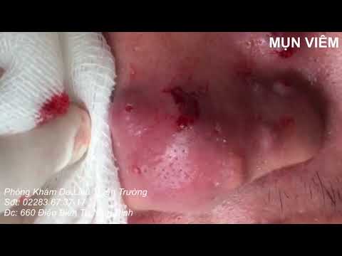 ĐẶC TRỊ MỤN VIÊM BẰNG PHƯƠNG PHÁP LASER AN TOÀN CHI PHÍ RẺ