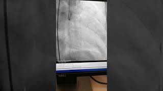 PCI ROTA CORONARY ANGIOGRAM LAD CALCIFIED LESION