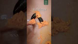 Introducing Leech Therapy | Ayurvedic Relief | Wellness Therapy | AVNA - The House of Herbs