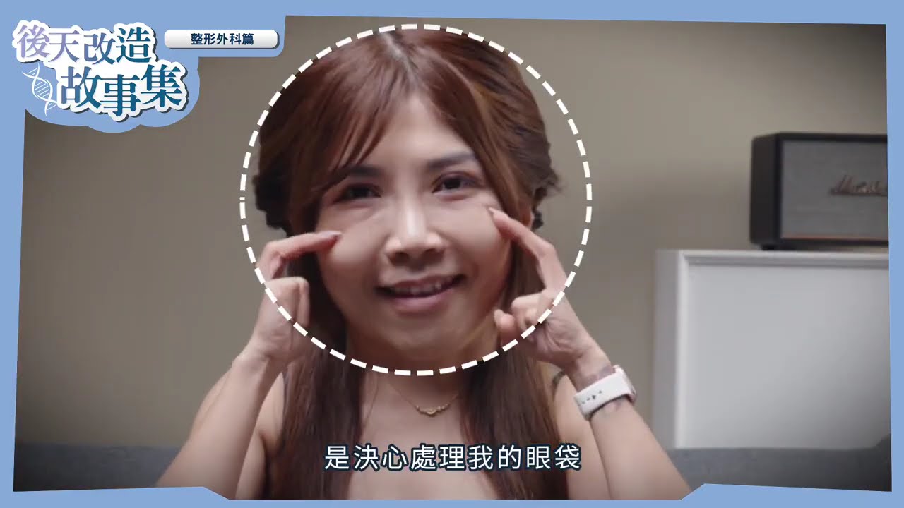👀 從泡泡眼到明亮水汪大眼｜眼袋內開合併自體脂肪補脂｜時尚假期醫美診所