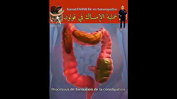 عملية الإمساك في قولون 