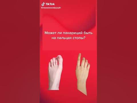 Может ли быть панариций на ноге? #shorts #хирургия #хирург - YouTube