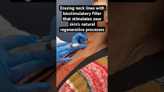 Erasing neck lines with Sculptra #antiaging #sculptra #over40 Profile