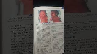 Langman Embryology Birth defects Ch#9 Part 1