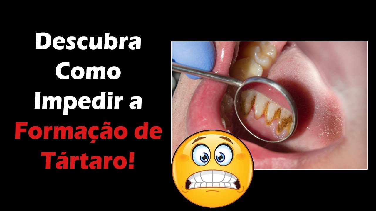 Como Evitar Tártaro nos Dentes - 3 Super Dicas CASEIRAS - YouTube