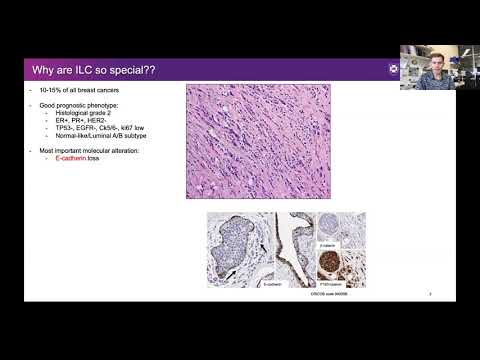 Video: Invasivt Lobulärt Karcinom I Bröstet: Morfologi, Biomarkörer Och 'omics