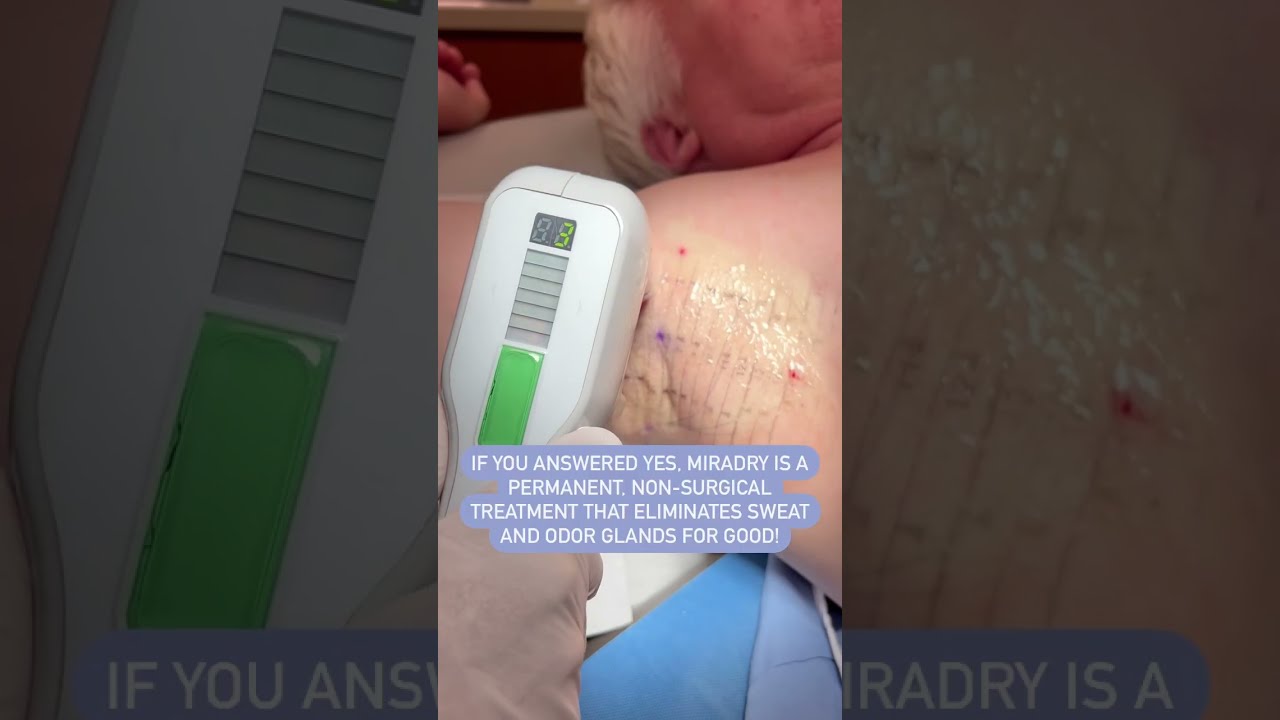 Excessive Sweating Treatment For Underarms