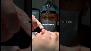 Мужская ринопластика#пластиканоса#посттравматика#носыазманова#ринопластика#симметрия#септопластика