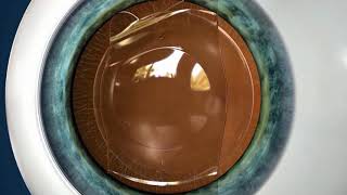 Visian ICL Procedure Overview Video