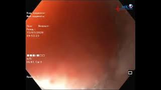 Endoscopic Band Ligation Esophagus Varices