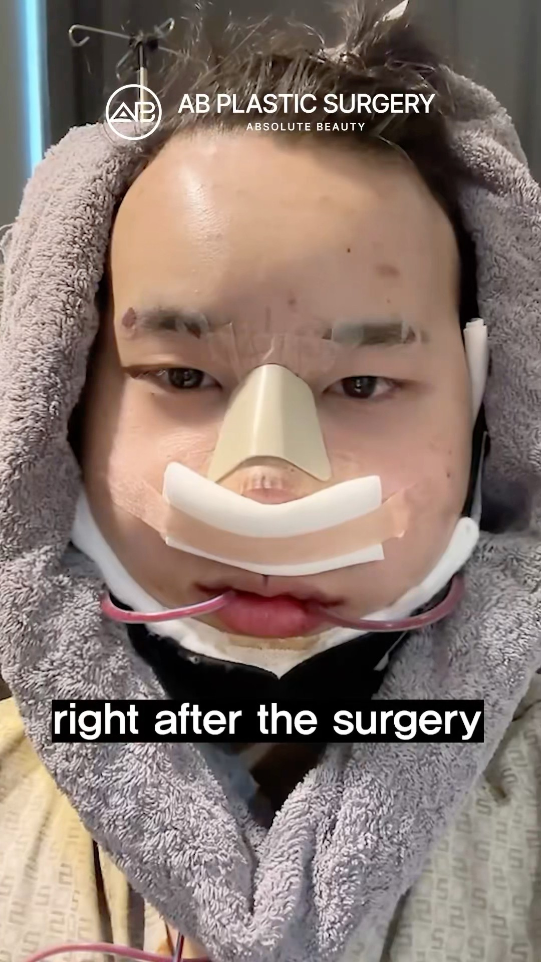 Male Rhinoplasty (Nose Job) Before & After! #koreanplasticsurgery