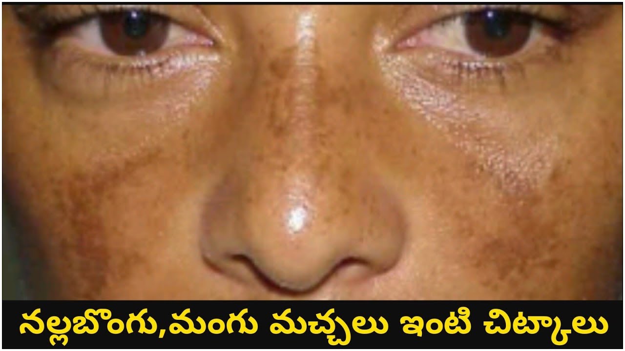 నల్లబొంగు,మంగు మచ్చలకు ఇంటి చిట్కాలు|How to get rid of hyperpigmentation  with easy home remedies| - YouTube