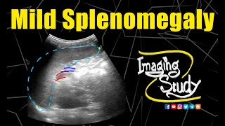 Mild Splenomegaly || Ultrasound || Case 150