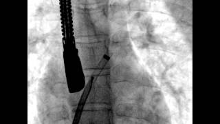 Vol.1 Issue 1 Video 17: Atrial septal defect: Step-by-Step catheter closure