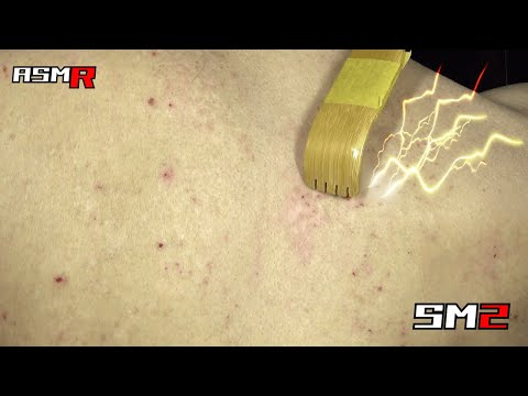 【痒いぃ~★アトピー性皮膚炎ASMR】冬場で悪化してきた背中を孫の手で掻いて気持ち良い音/癒し/リラックス効果/睡眠導入/マッサージ