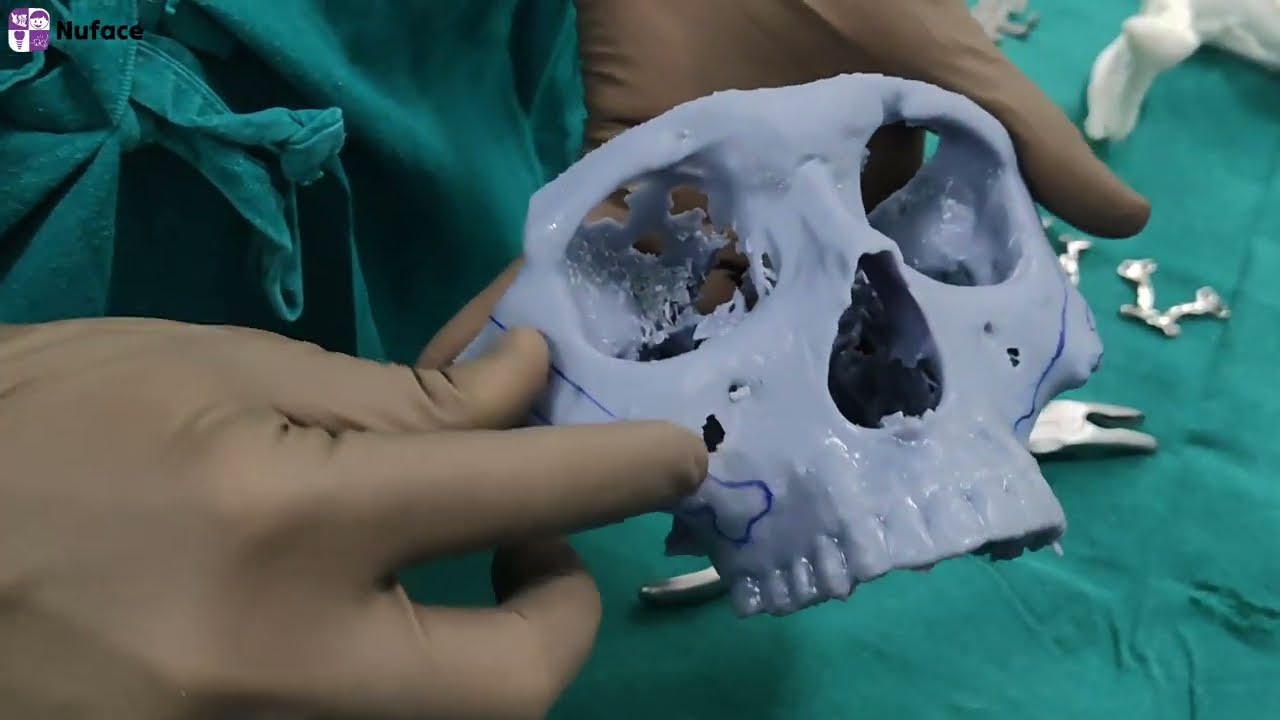 Операция по маскулинизации лица с использованием индивидуально подобранных имплантатов (PSI) | До...