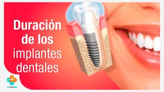 Duración de los implantes dentales | Tu Salud Guía