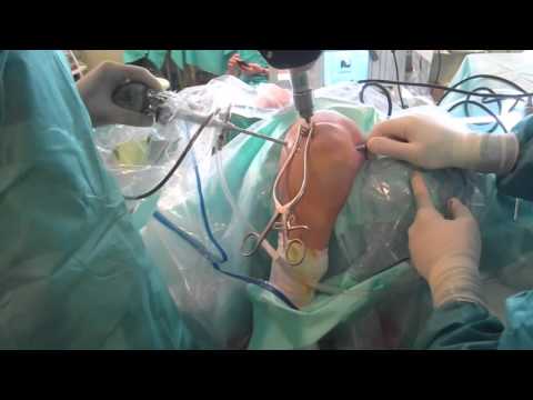Fractura de Codo asistida por Artroscopia (Dr Bernaldez)