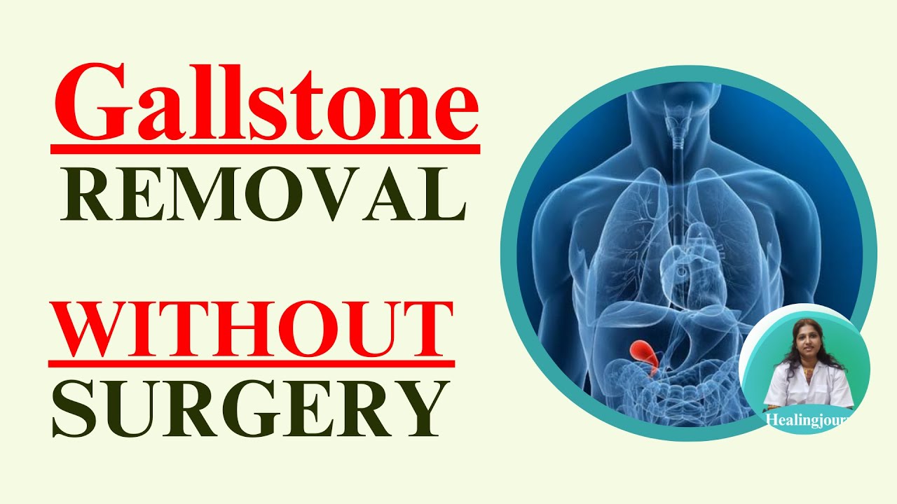 Remove Gallstone By Acupuncture No Pill No Surgery Healing Journy