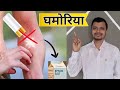 Heat Rash : Cooling Down the Burn By Understanding its Root Cause .