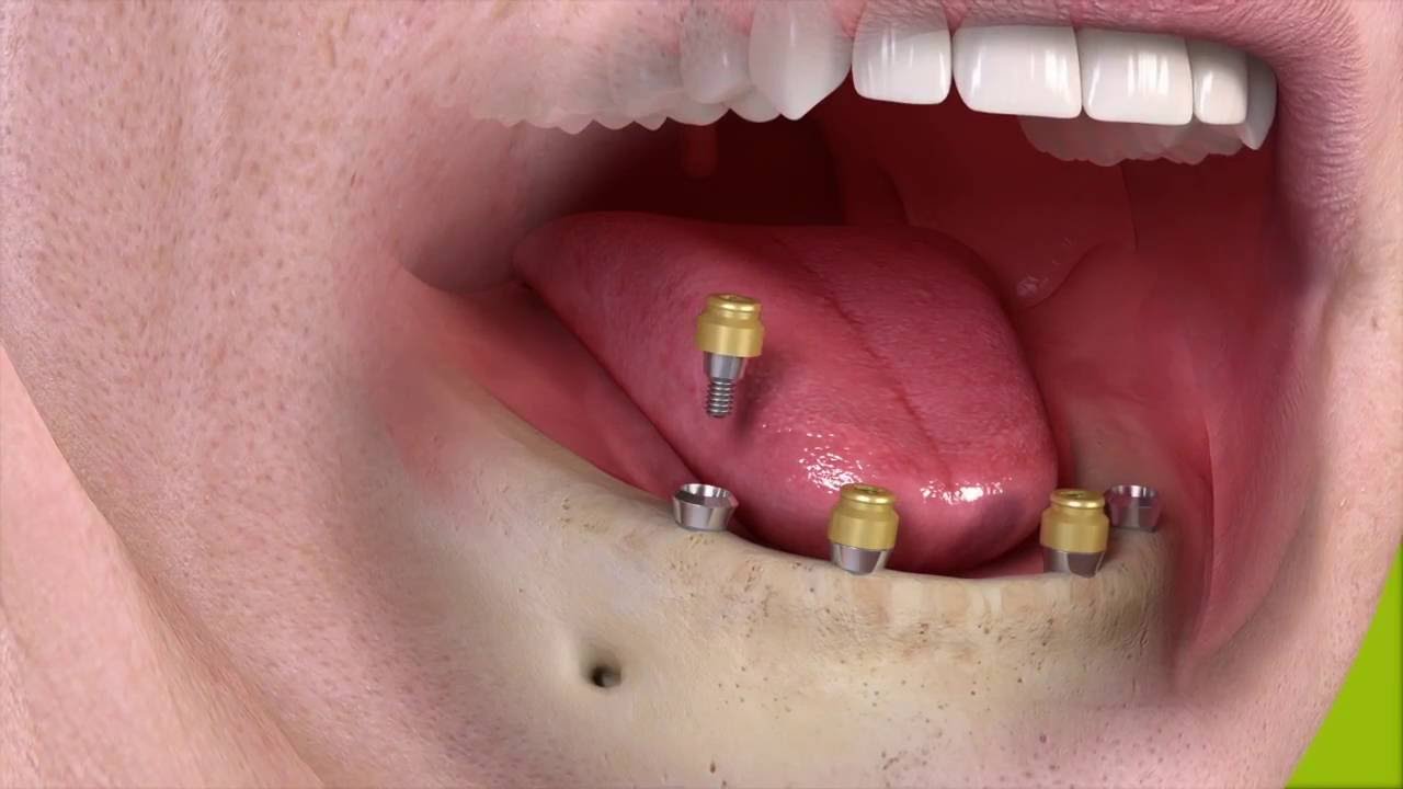Complete Tooth Replacement with a Removable Dental Implant Retained