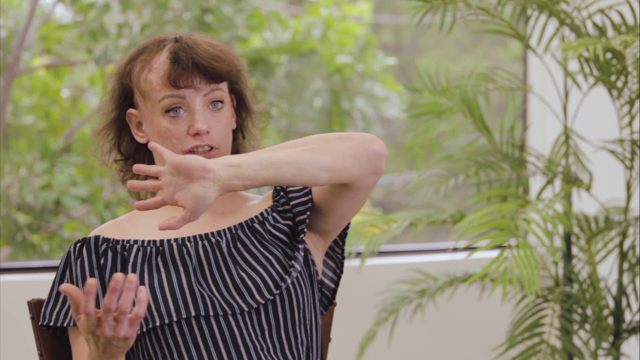 Scalp Burn Survivor Misty's Hair Restoration with CNC Hair Prosthesis