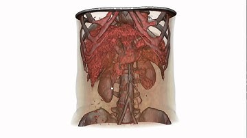 Fast Deformation of Volume Data Using Tetrahedral Mesh Rasterization: demoMedic