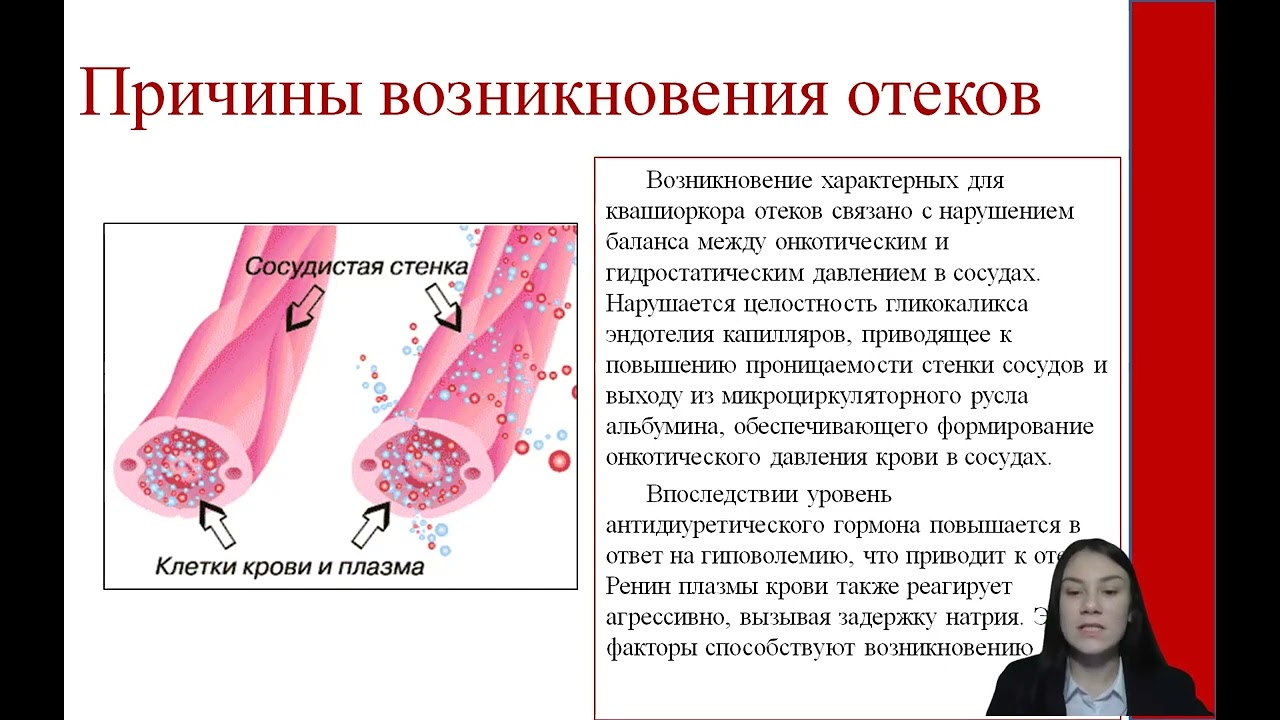 61. КВАШИОРКОР: ПАТОГЕНЕЗ И ОСНОВНЫЕ КЛИНИЧЕСКИЕ ПРОЯВЛЕНИЯ (ОБЗОР ЛИТЕРАТУРЫ)