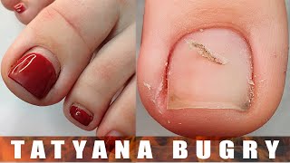 Ingrown Nail Care | Red Pedicure | The Steps To A Perfect Russian, Efile Pedicure