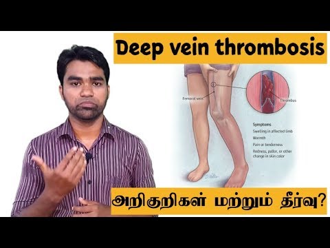 tamil bigg boss 3 Deep vein thrombosis treatment in tamil | DVT herbal treatment | டீப் வெயின் துரெம்போசிஸ்