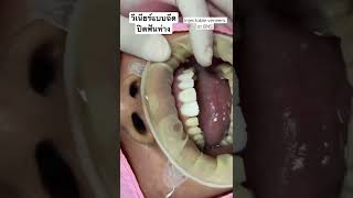 ฟันห่างทำไงดี ทำวีเนียร์แบบฉีดแก้ได้ | #shorts #dentist #cosmeticdentist #dentalveneers