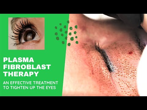 Video: Plasmafibroblastterapi: Prosedyre, Fordeler Og Effektivitet