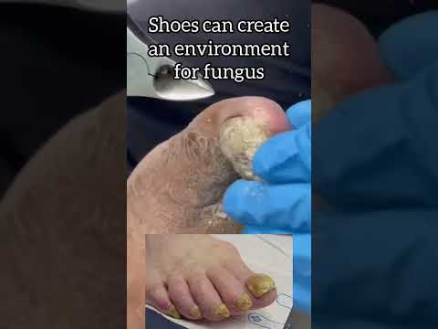 Why you should walk barefoot ep 29 | Nail fungus again #shorts